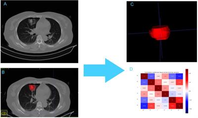 A CT-Based Radiomics Nomogram to Predict Complete Ablation of Pulmonary Malignancy: A Multicenter Study